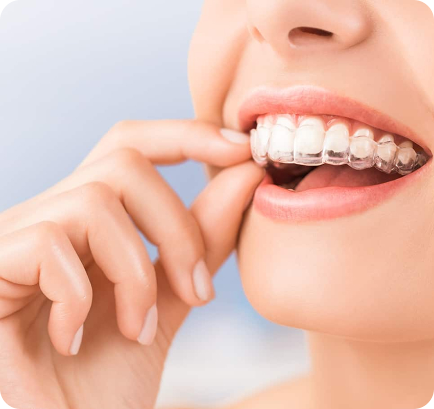 Ortodoncia invisible